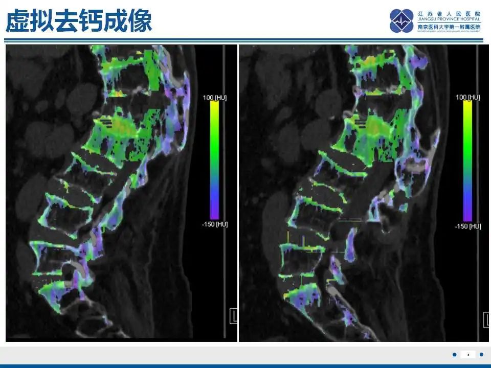 影像PPT - 【PPT】虚拟去钙技术在骨髓水肿中的应用-6