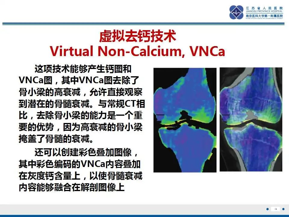 影像PPT - 【PPT】虚拟去钙技术在骨髓水肿中的应用-16