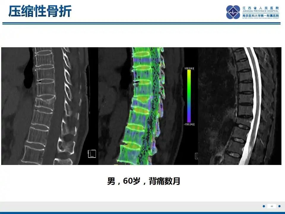 影像PPT - 【PPT】虚拟去钙技术在骨髓水肿中的应用-24