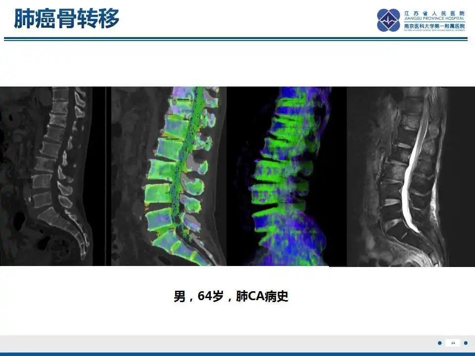 影像PPT - 【PPT】虚拟去钙技术在骨髓水肿中的应用-25