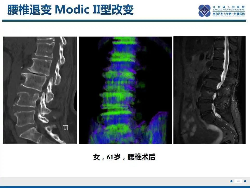 影像PPT - 【PPT】虚拟去钙技术在骨髓水肿中的应用-26