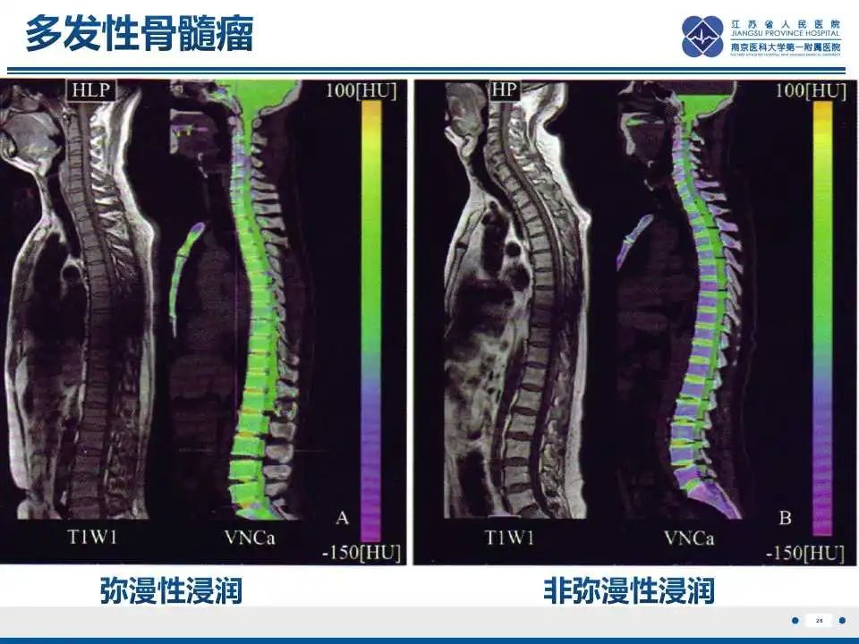 影像PPT - 【PPT】虚拟去钙技术在骨髓水肿中的应用-27