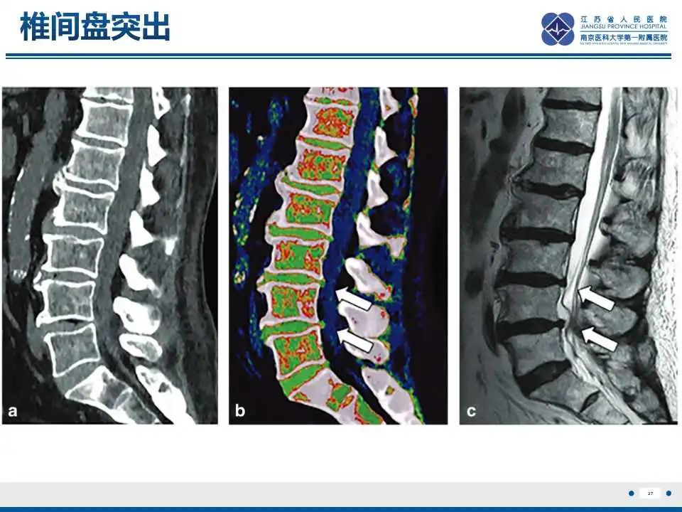 影像PPT - 【PPT】虚拟去钙技术在骨髓水肿中的应用-28