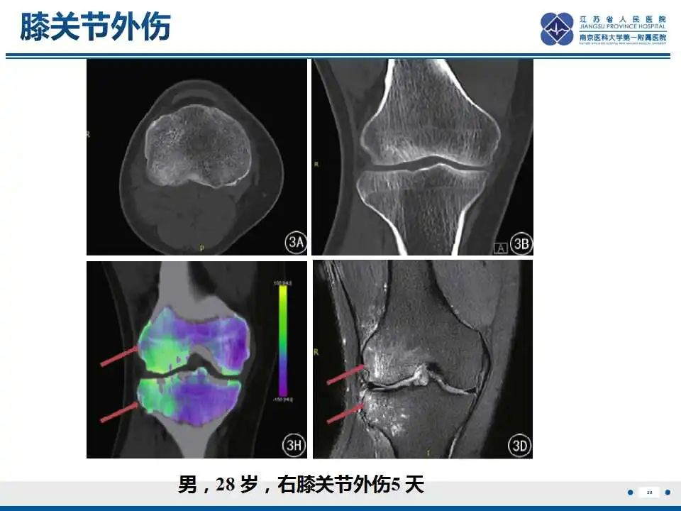 影像PPT - 【PPT】虚拟去钙技术在骨髓水肿中的应用-29