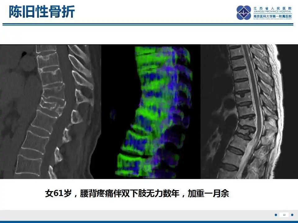 影像PPT - 【PPT】虚拟去钙技术在骨髓水肿中的应用-23
