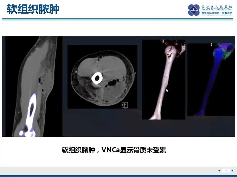 影像PPT - 【PPT】虚拟去钙技术在骨髓水肿中的应用-31