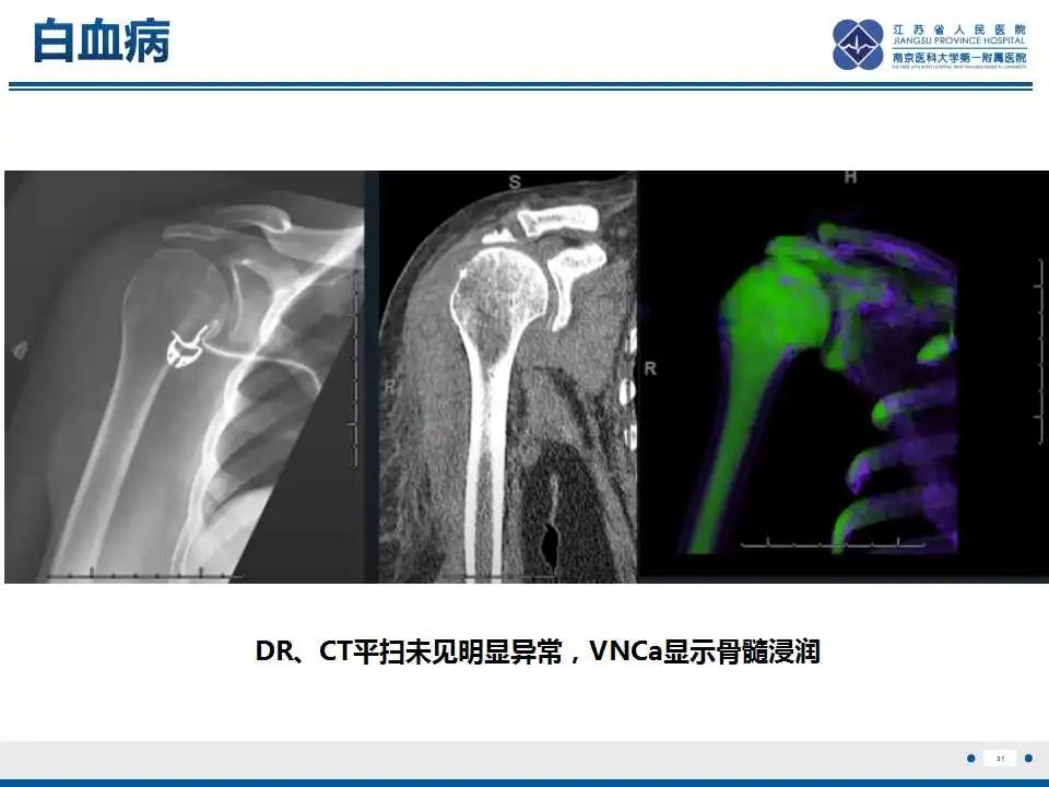 影像PPT - 【PPT】虚拟去钙技术在骨髓水肿中的应用-32
