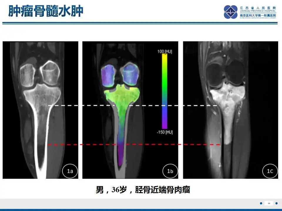 影像PPT - 【PPT】虚拟去钙技术在骨髓水肿中的应用-30