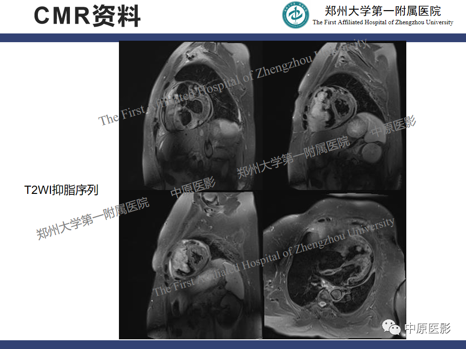 影像PPT - 【病例】心脏肉瘤1例MR影像-4