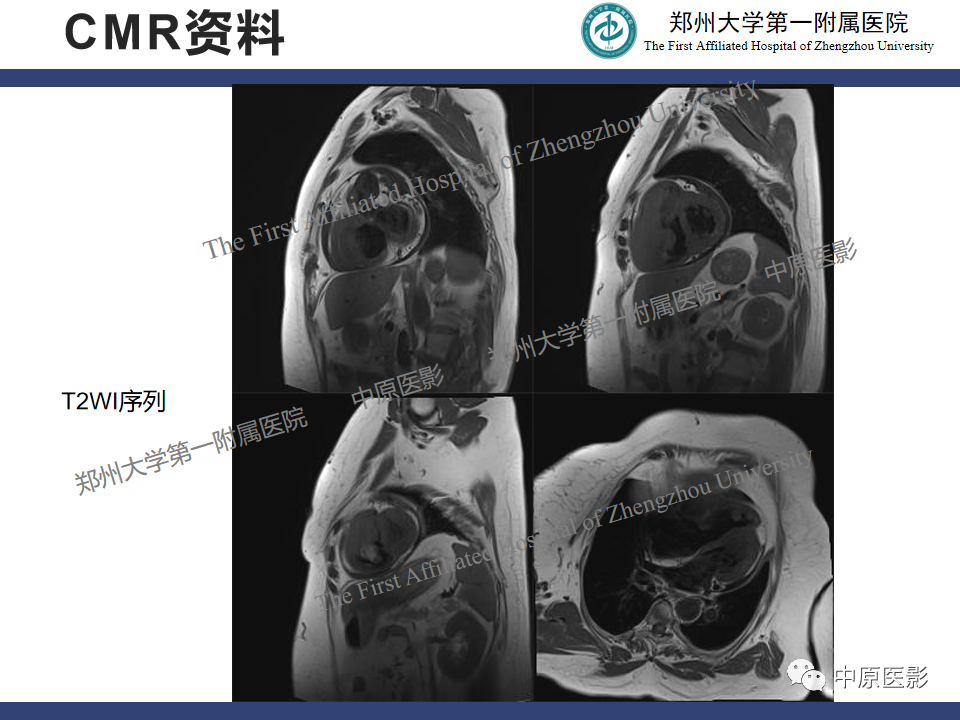 影像PPT - 【病例】心脏肉瘤1例MR影像-3
