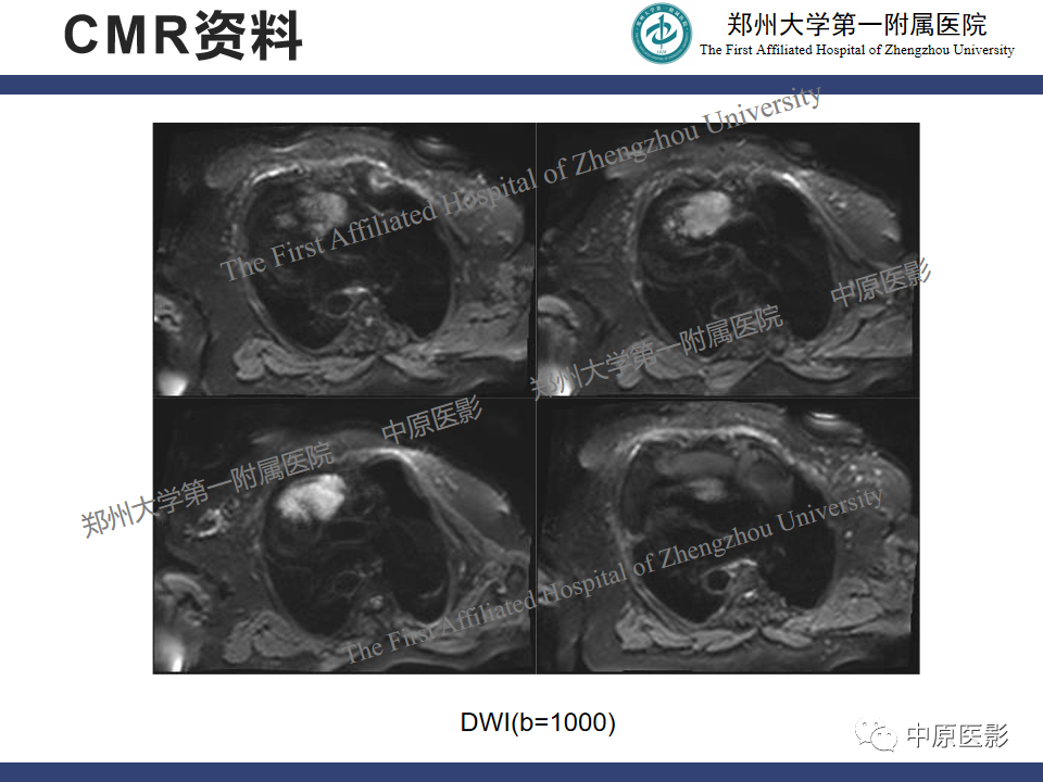 影像PPT - 【病例】心脏肉瘤1例MR影像-5