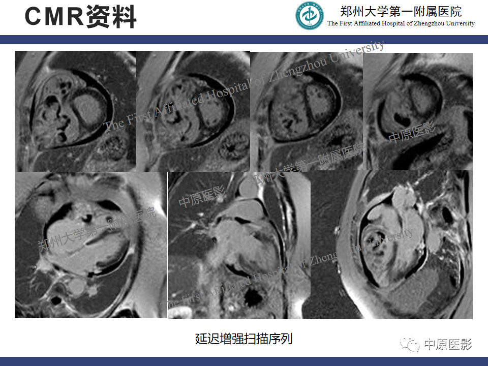 影像PPT - 【病例】心脏肉瘤1例MR影像-6
