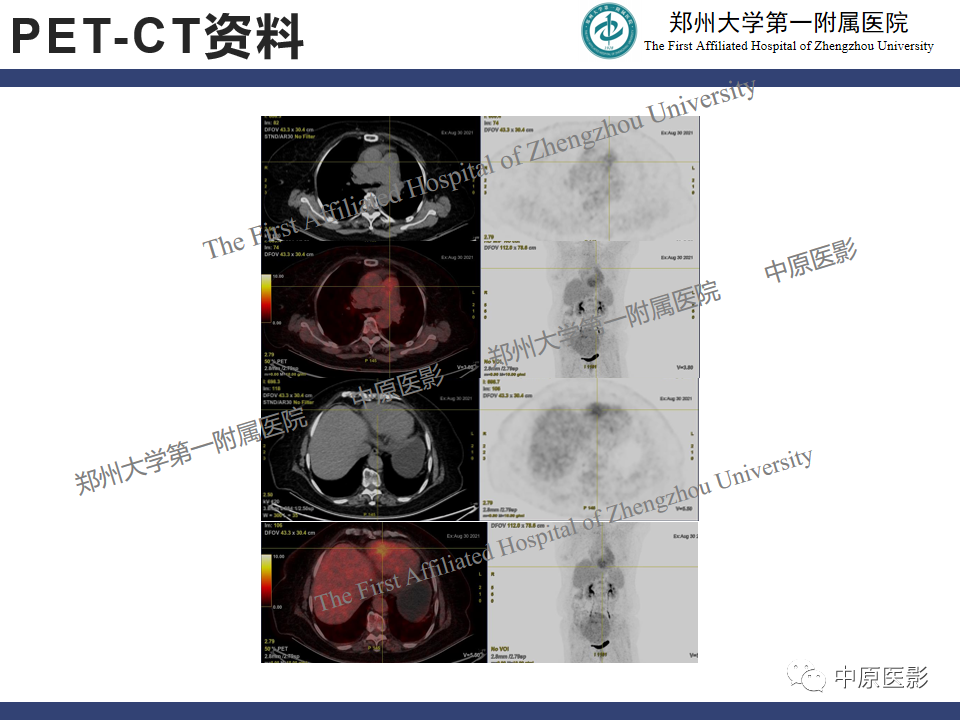 影像PPT - 【病例】心脏肉瘤1例MR影像-7