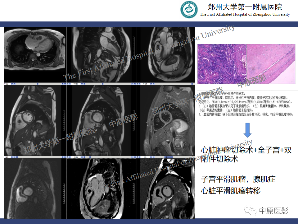 影像PPT - 【病例】心脏肉瘤1例MR影像-14