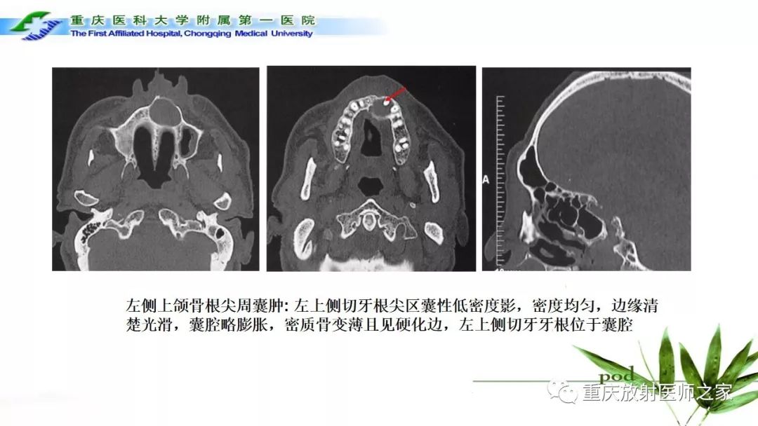 影像PPT - 【PPT】颌骨常见肿瘤及肿瘤样病变的CT诊断及鉴别诊断-7