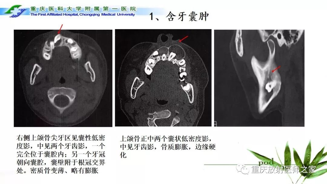 影像PPT - 【PPT】颌骨常见肿瘤及肿瘤样病变的CT诊断及鉴别诊断-9