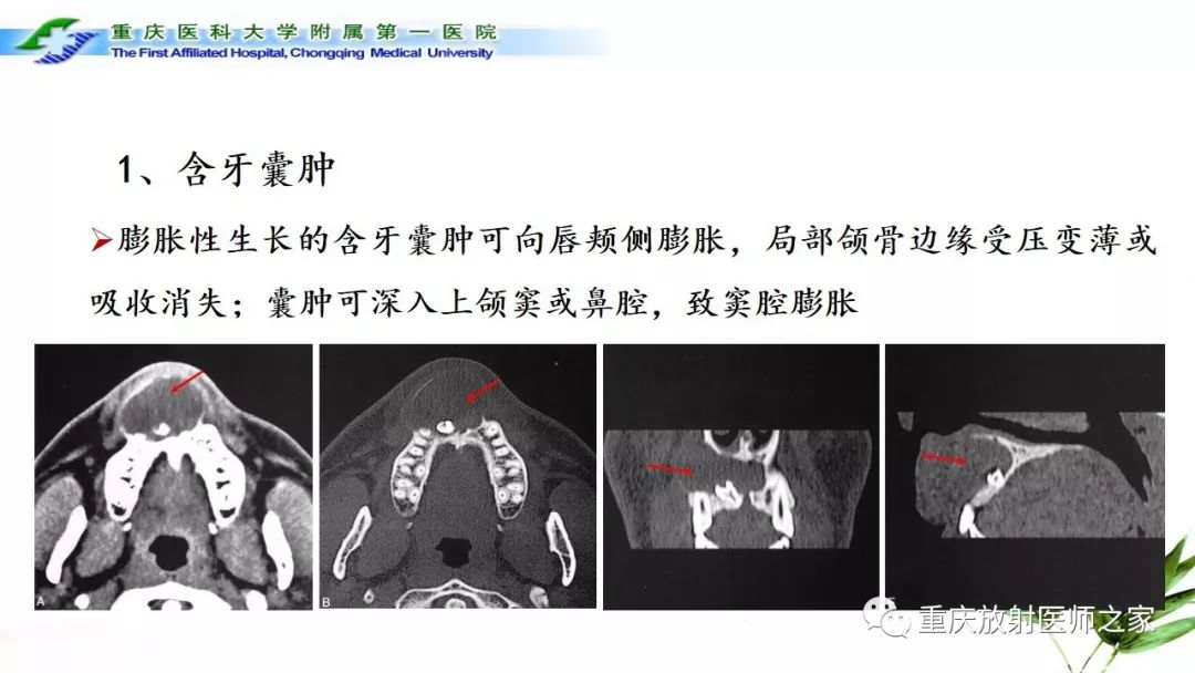 影像PPT - 【PPT】颌骨常见肿瘤及肿瘤样病变的CT诊断及鉴别诊断-10