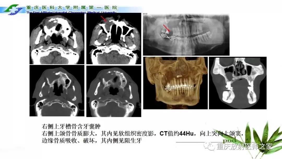 影像PPT - 【PPT】颌骨常见肿瘤及肿瘤样病变的CT诊断及鉴别诊断-11