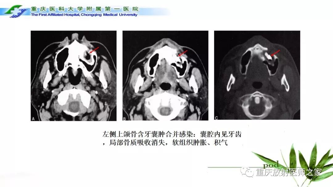 影像PPT - 【PPT】颌骨常见肿瘤及肿瘤样病变的CT诊断及鉴别诊断-12