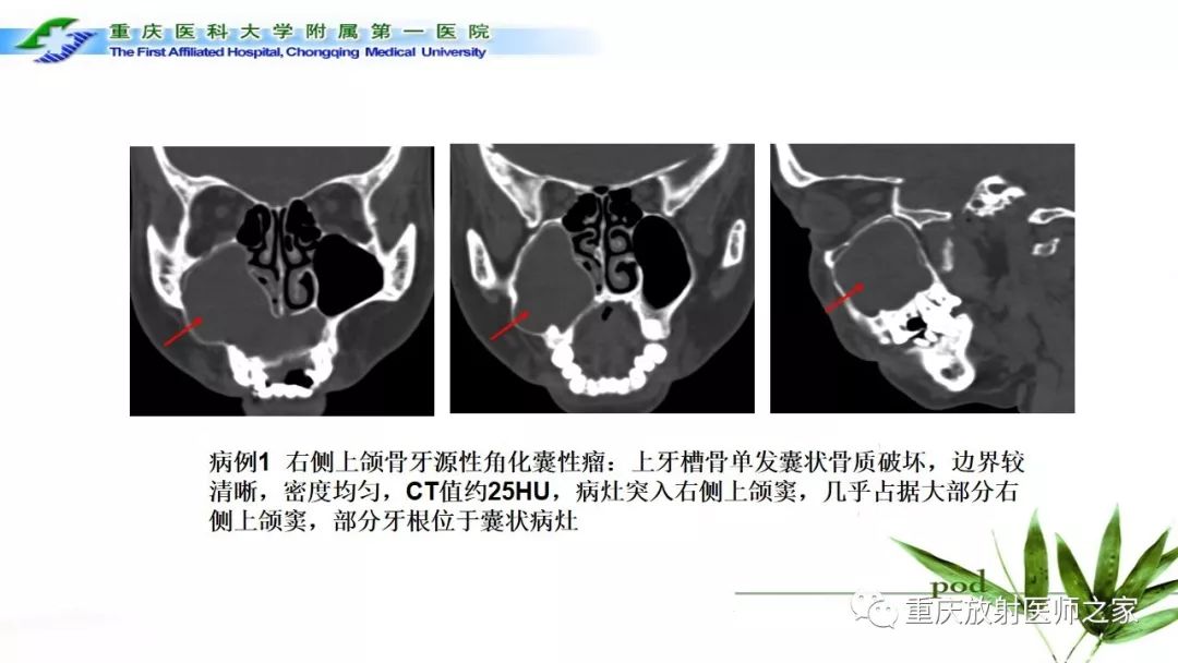 影像PPT - 【PPT】颌骨常见肿瘤及肿瘤样病变的CT诊断及鉴别诊断-15