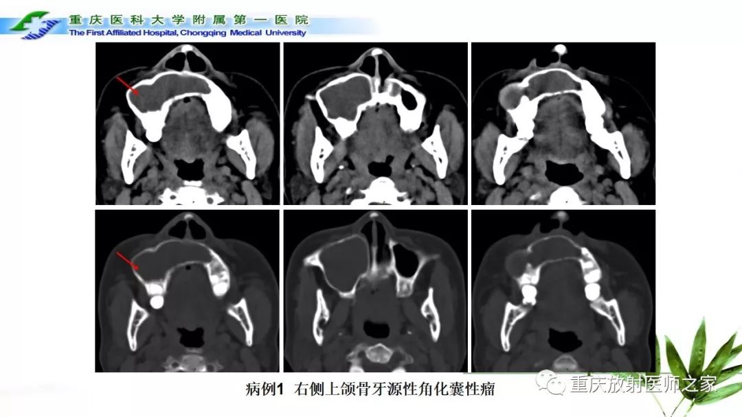 影像PPT - 【PPT】颌骨常见肿瘤及肿瘤样病变的CT诊断及鉴别诊断-14