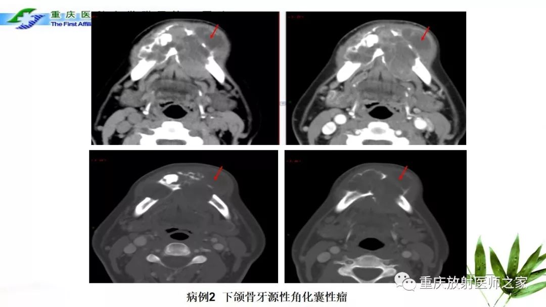 影像PPT - 【PPT】颌骨常见肿瘤及肿瘤样病变的CT诊断及鉴别诊断-16