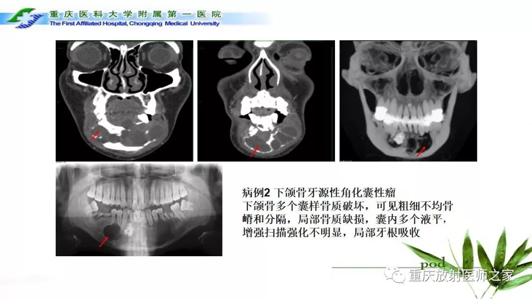 影像PPT - 【PPT】颌骨常见肿瘤及肿瘤样病变的CT诊断及鉴别诊断-17