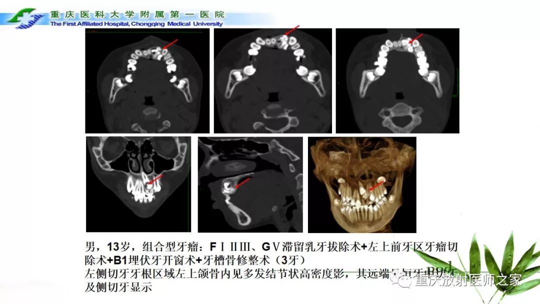 影像PPT - 【PPT】颌骨常见肿瘤及肿瘤样病变的CT诊断及鉴别诊断-21