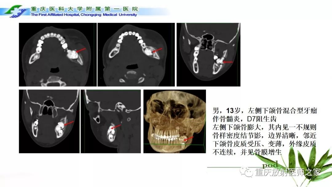 影像PPT - 【PPT】颌骨常见肿瘤及肿瘤样病变的CT诊断及鉴别诊断-22