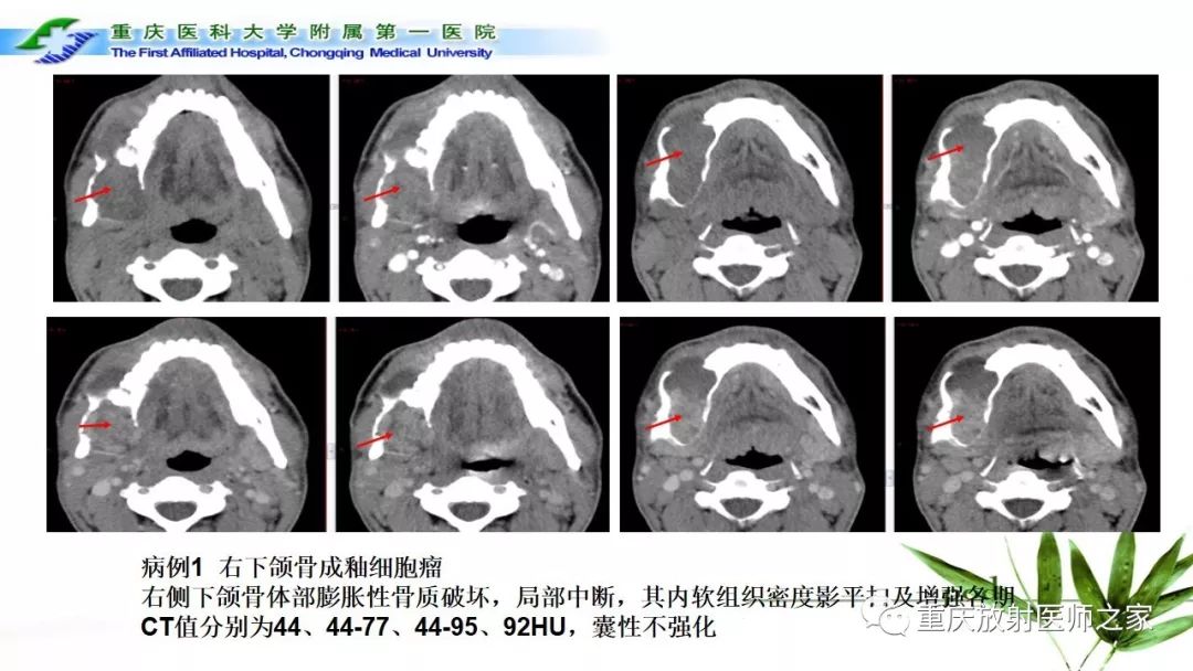 影像PPT - 【PPT】颌骨常见肿瘤及肿瘤样病变的CT诊断及鉴别诊断-25