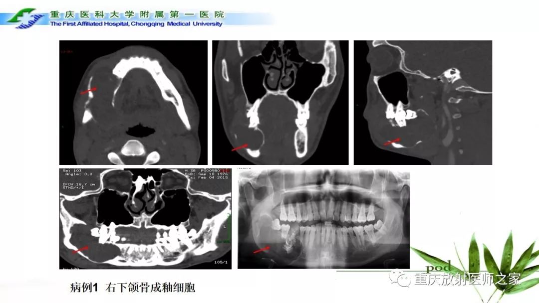 影像PPT - 【PPT】颌骨常见肿瘤及肿瘤样病变的CT诊断及鉴别诊断-26