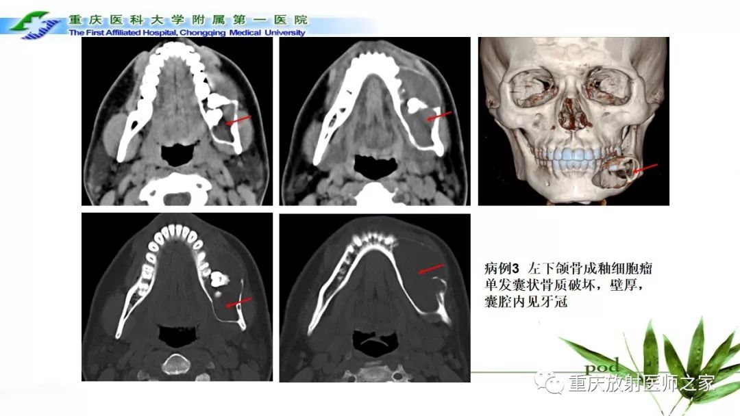 影像PPT - 【PPT】颌骨常见肿瘤及肿瘤样病变的CT诊断及鉴别诊断-28