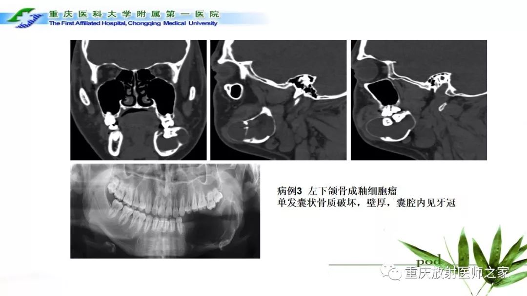 影像PPT - 【PPT】颌骨常见肿瘤及肿瘤样病变的CT诊断及鉴别诊断-29