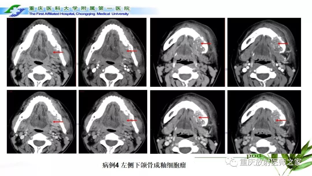 影像PPT - 【PPT】颌骨常见肿瘤及肿瘤样病变的CT诊断及鉴别诊断-30