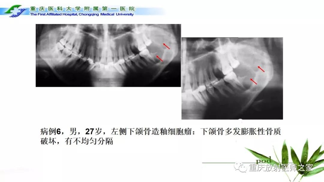 影像PPT - 【PPT】颌骨常见肿瘤及肿瘤样病变的CT诊断及鉴别诊断-34
