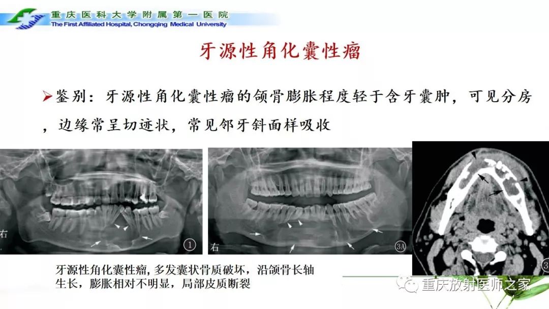 影像PPT - 【PPT】颌骨常见肿瘤及肿瘤样病变的CT诊断及鉴别诊断-35