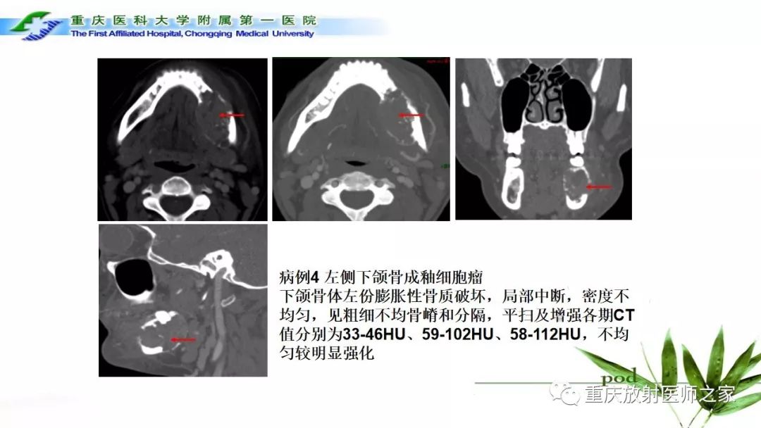 影像PPT - 【PPT】颌骨常见肿瘤及肿瘤样病变的CT诊断及鉴别诊断-31