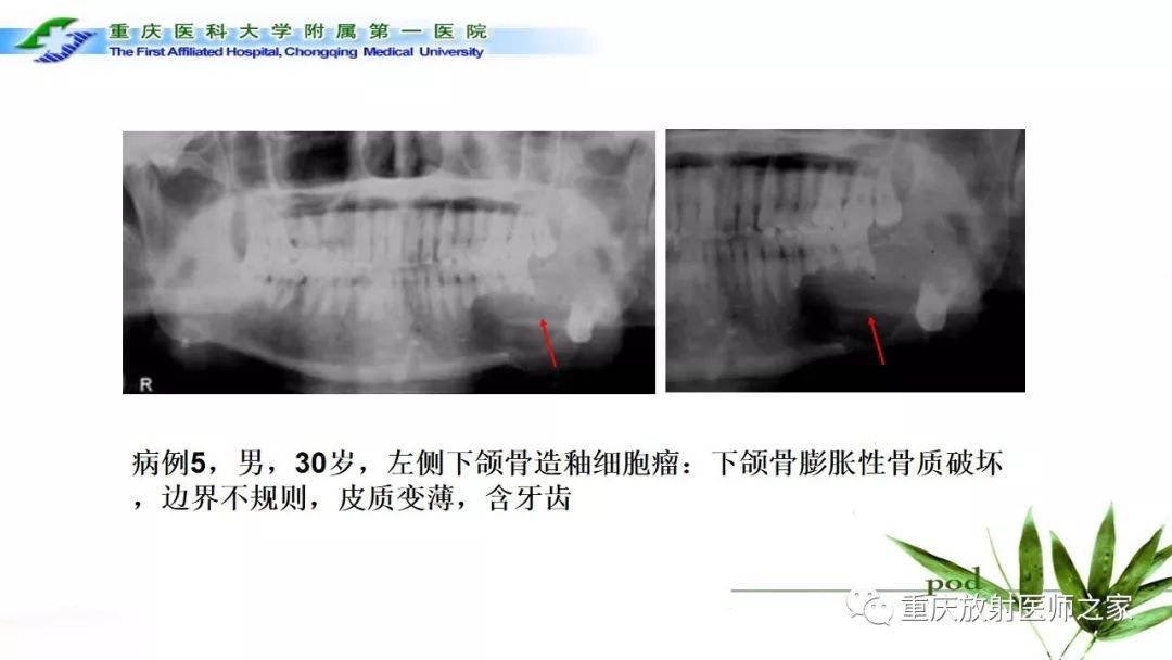 影像PPT - 【PPT】颌骨常见肿瘤及肿瘤样病变的CT诊断及鉴别诊断-33