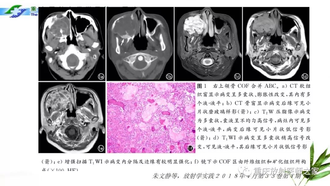 影像PPT - 【PPT】颌骨常见肿瘤及肿瘤样病变的CT诊断及鉴别诊断-41