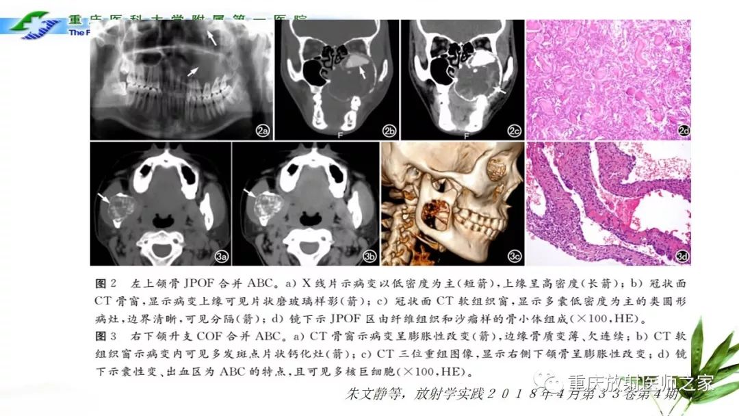 影像PPT - 【PPT】颌骨常见肿瘤及肿瘤样病变的CT诊断及鉴别诊断-42