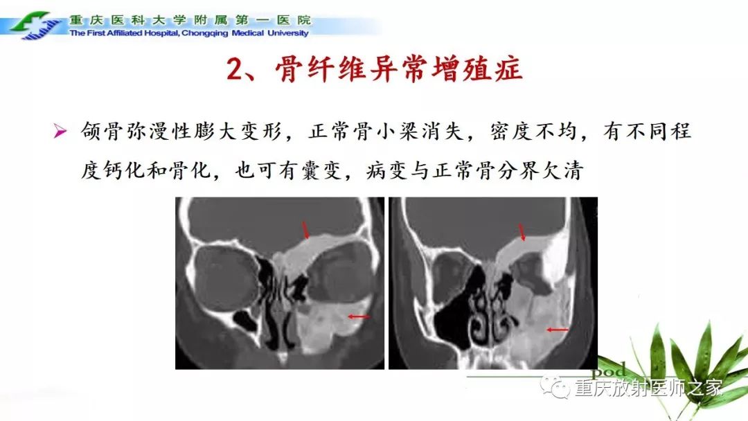 影像PPT - 【PPT】颌骨常见肿瘤及肿瘤样病变的CT诊断及鉴别诊断-46