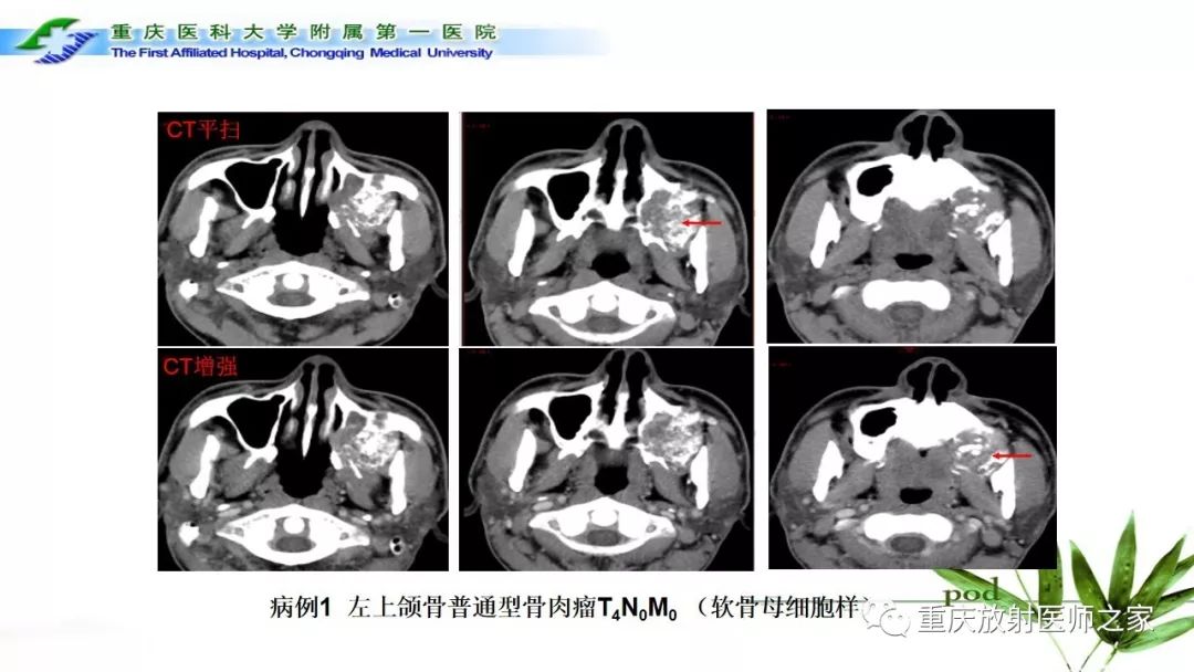 影像PPT - 【PPT】颌骨常见肿瘤及肿瘤样病变的CT诊断及鉴别诊断-50