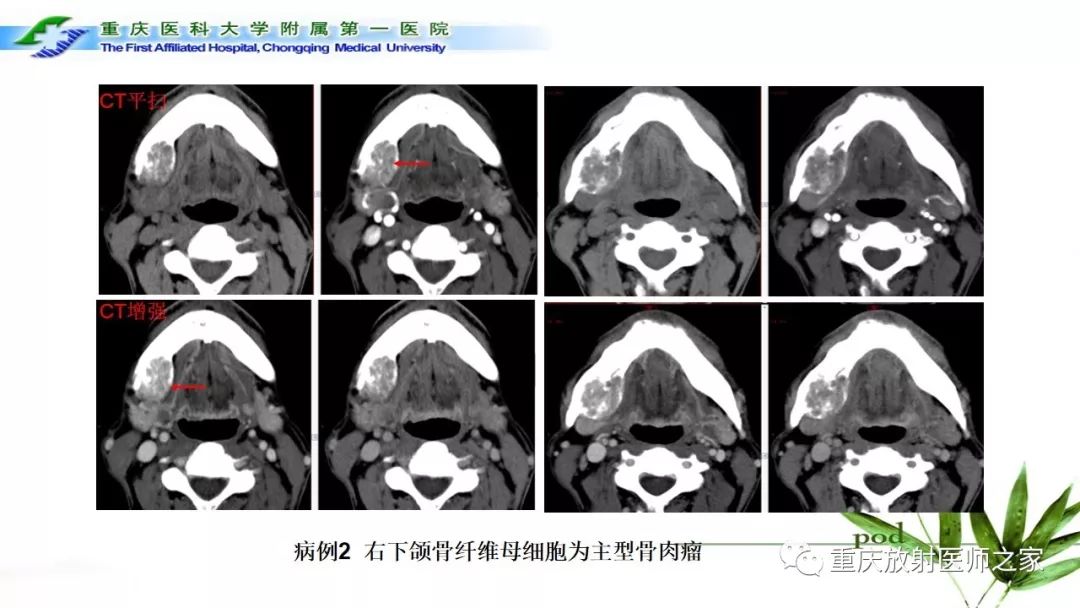 影像PPT - 【PPT】颌骨常见肿瘤及肿瘤样病变的CT诊断及鉴别诊断-52