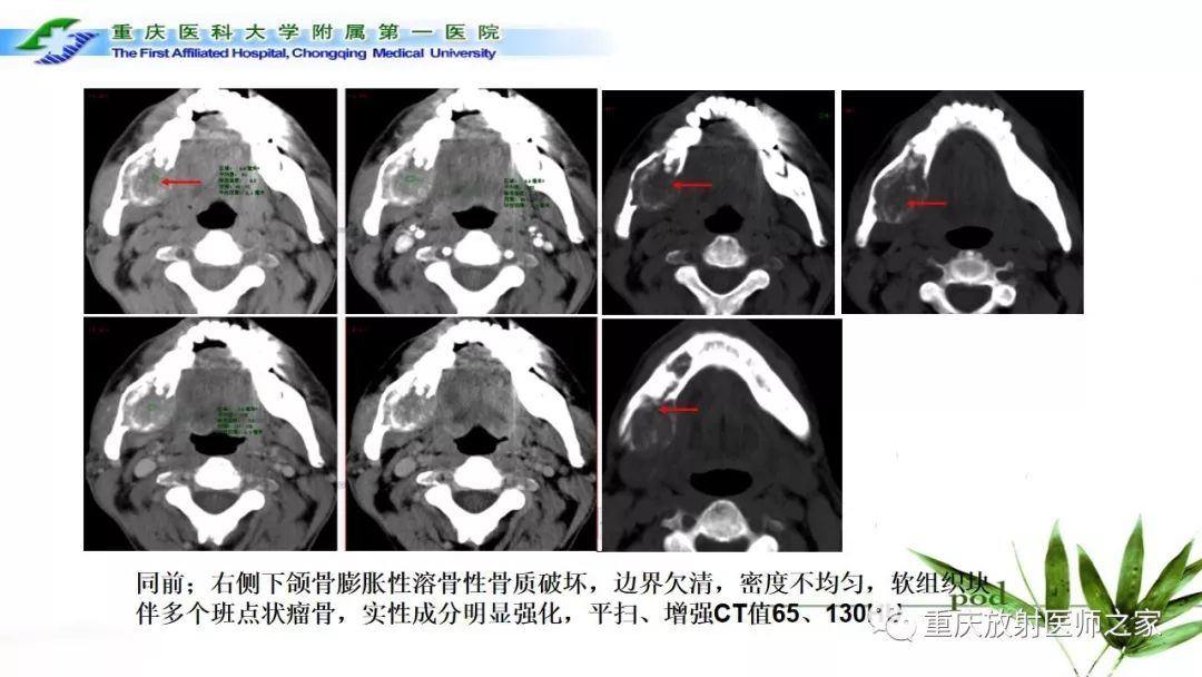 影像PPT - 【PPT】颌骨常见肿瘤及肿瘤样病变的CT诊断及鉴别诊断-53