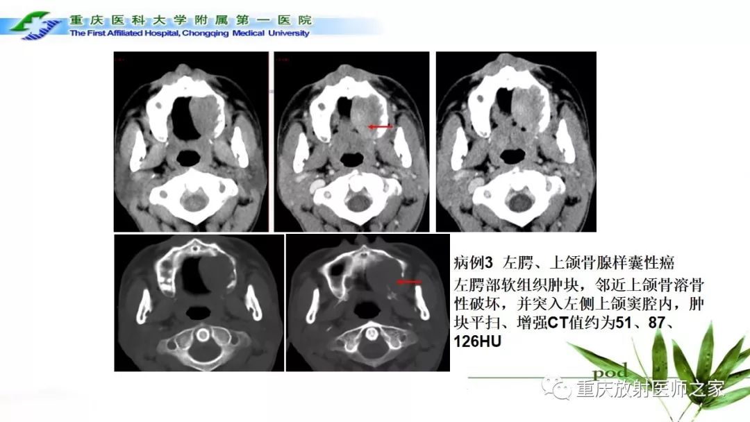 影像PPT - 【PPT】颌骨常见肿瘤及肿瘤样病变的CT诊断及鉴别诊断-55
