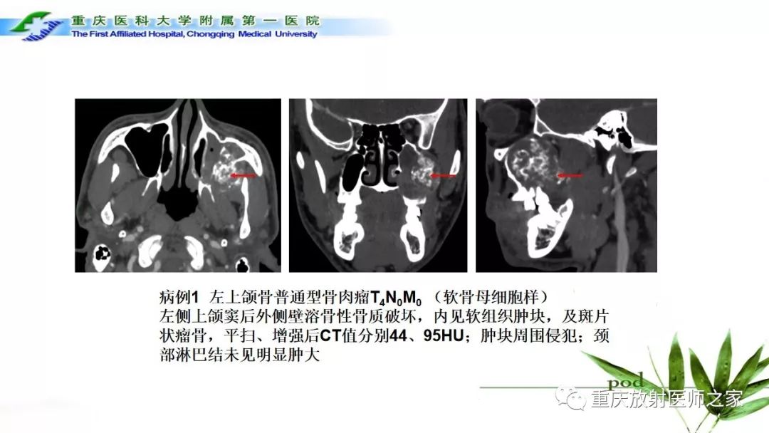 影像PPT - 【PPT】颌骨常见肿瘤及肿瘤样病变的CT诊断及鉴别诊断-51