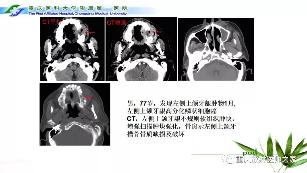 影像PPT - 【PPT】颌骨常见肿瘤及肿瘤样病变的CT诊断及鉴别诊断-57