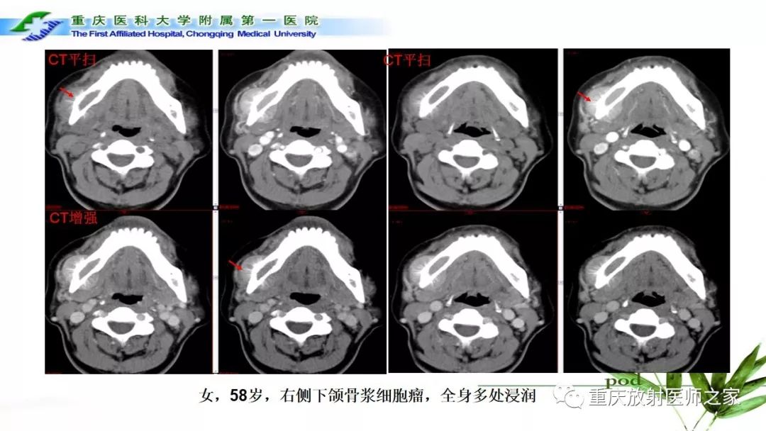 影像PPT - 【PPT】颌骨常见肿瘤及肿瘤样病变的CT诊断及鉴别诊断-58