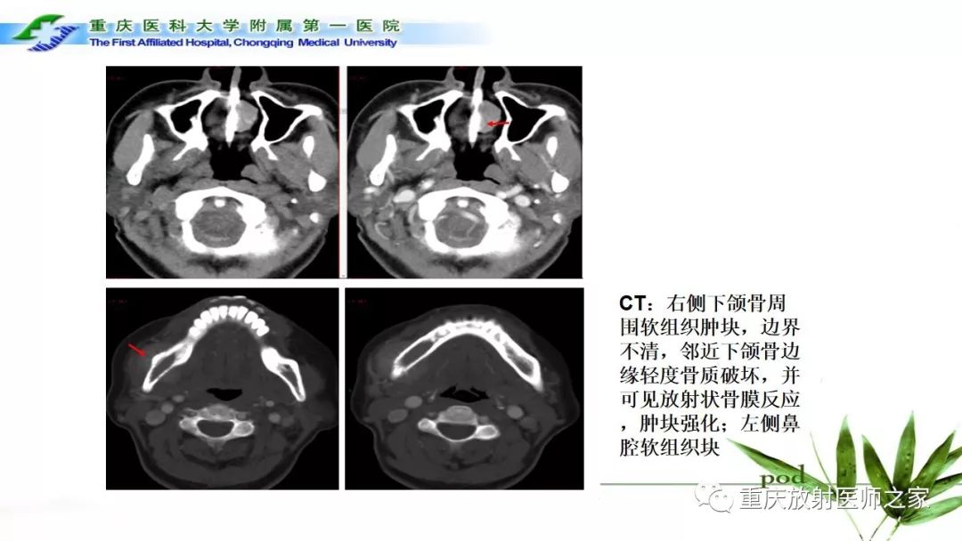影像PPT - 【PPT】颌骨常见肿瘤及肿瘤样病变的CT诊断及鉴别诊断-59
