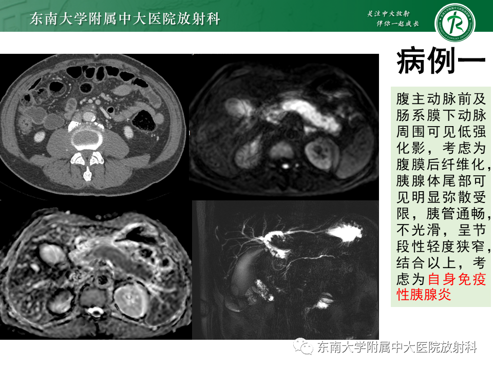 影像PPT - 【PPT】胰腺癌鉴别诊断-7 影像PPT - 【PPT】胰腺癌鉴别诊断-7